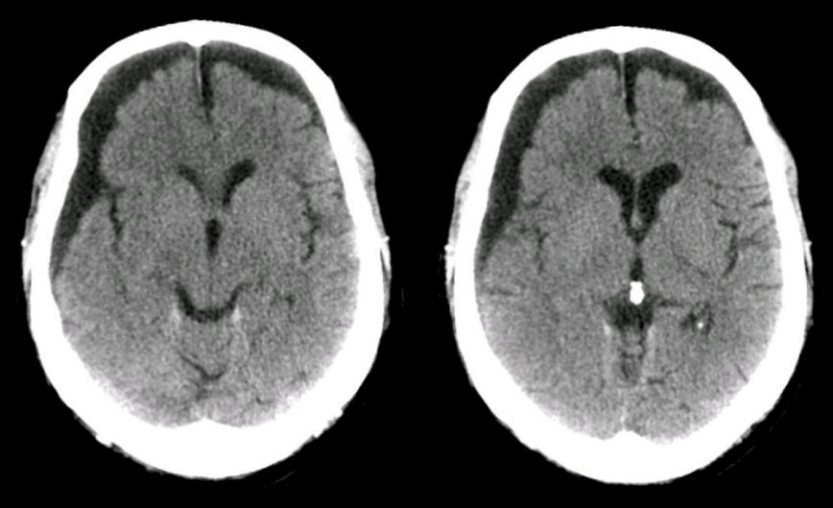 subdural-hematomac